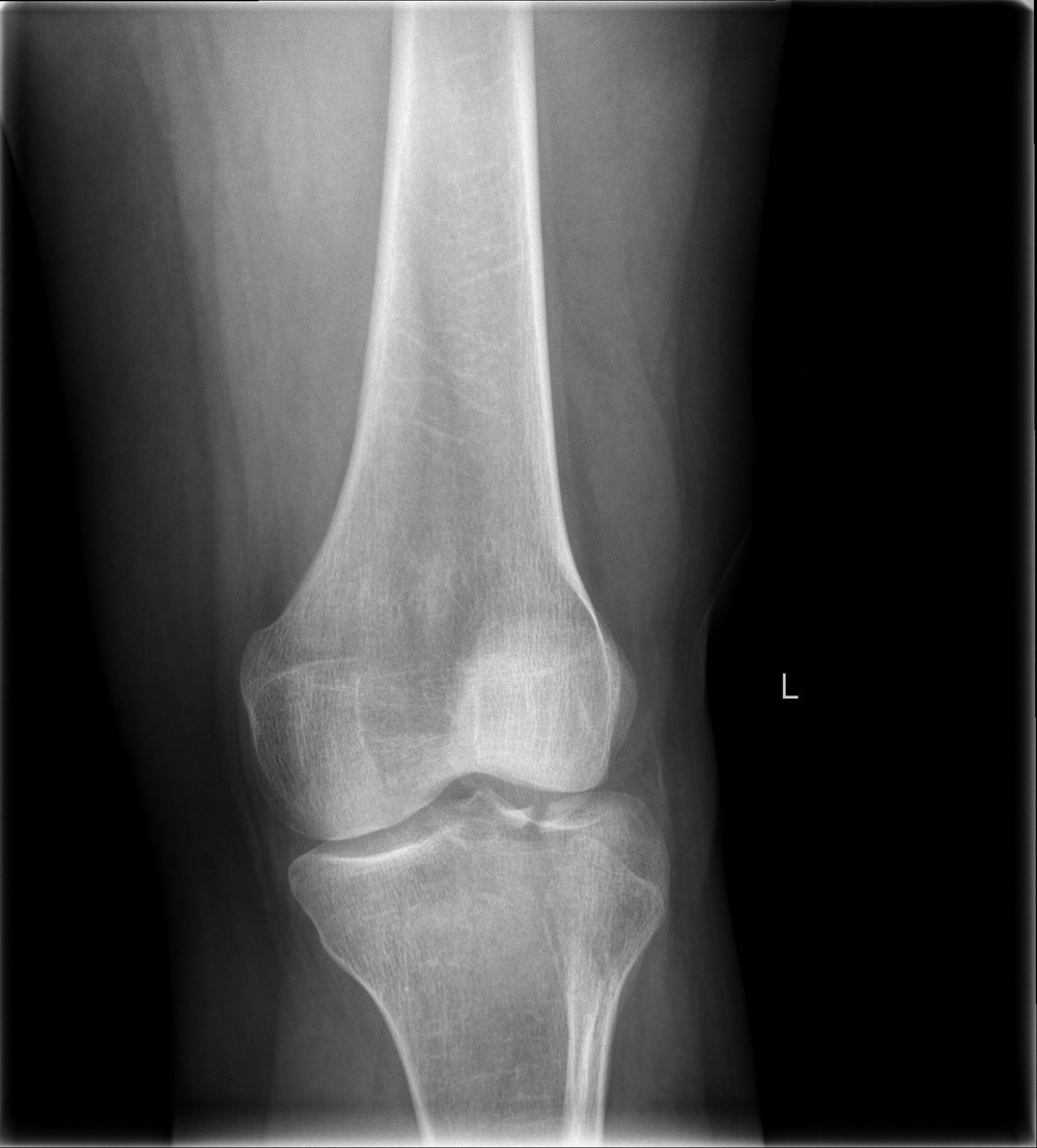 Knee radiograph with an example AI marking on the lateral tibial plateau