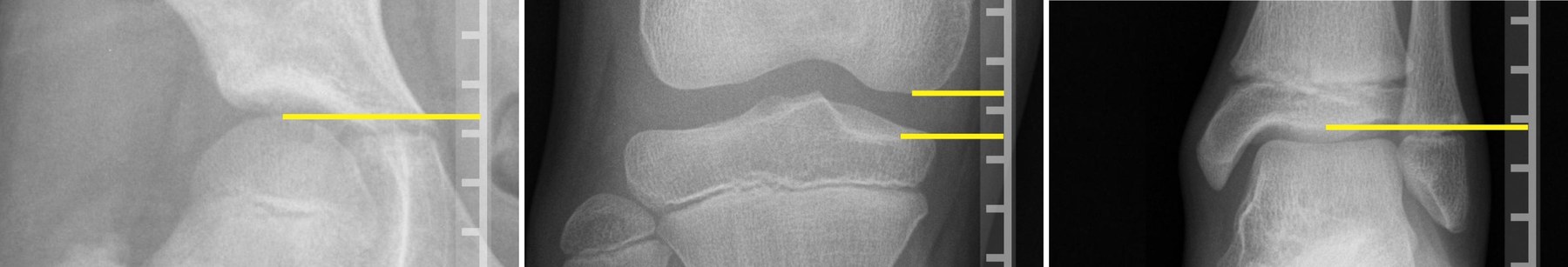 Hip, knee and ankle radiographs with a ruler and yellow lines marking joint levels for a leg length measurement